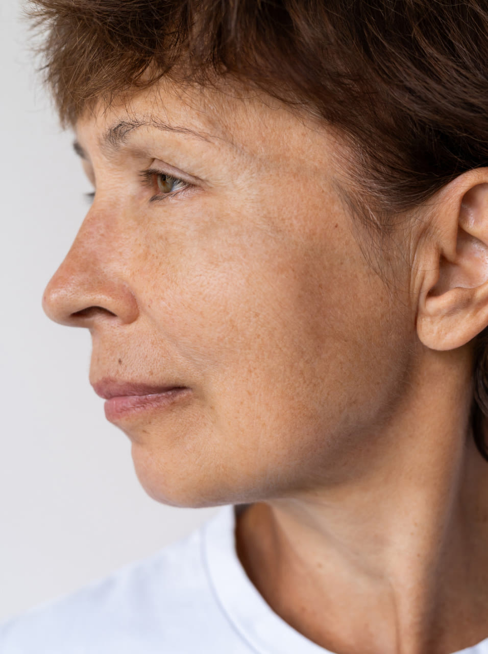 Nachher-Aufnahme: Hautbild im Gesichtsprofil