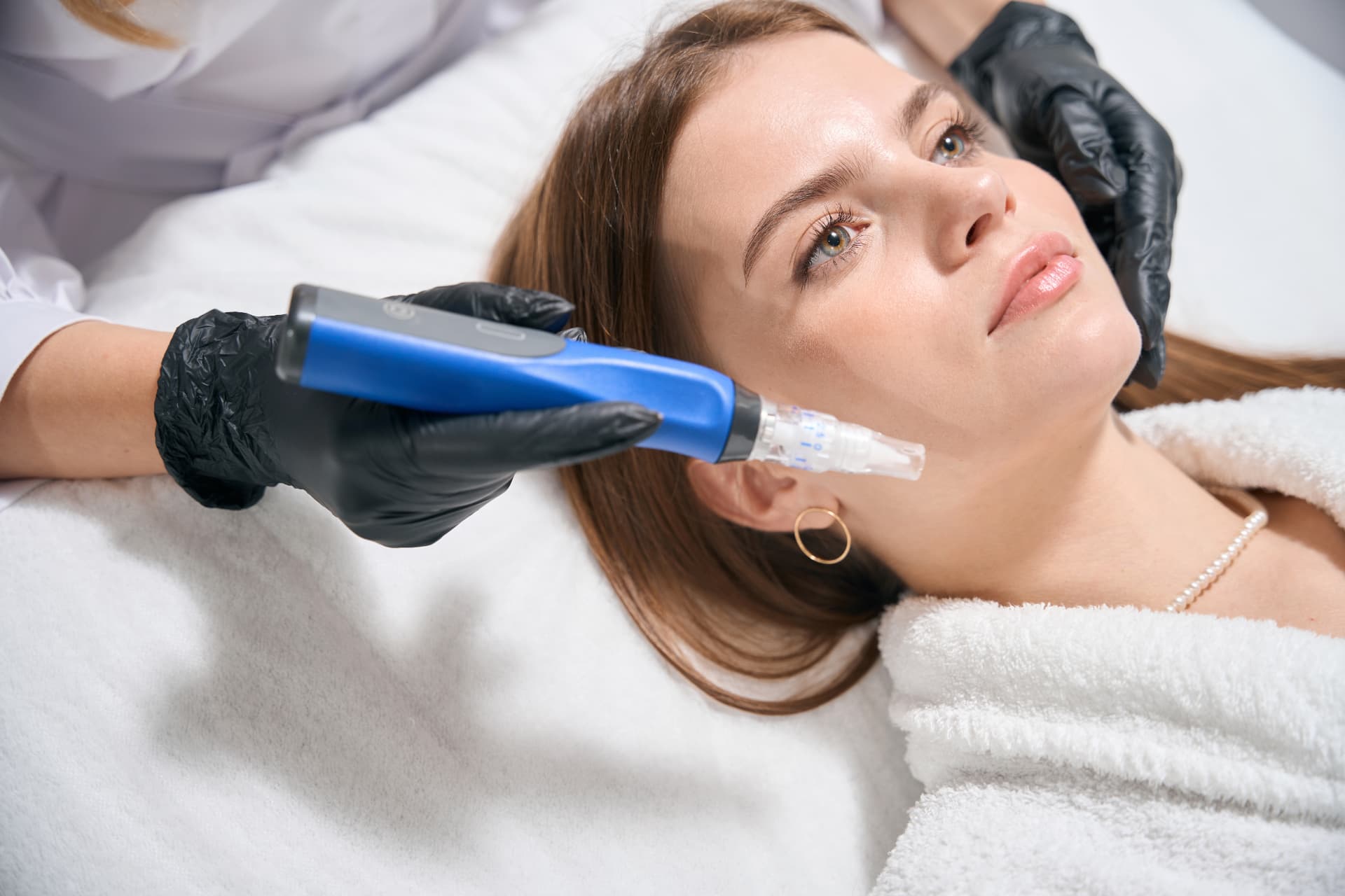 Symbolbild: Microneedling-Behandlung im Gesicht